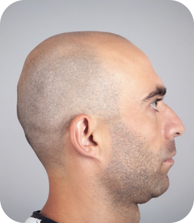 Minoxidil (Rogaine) for Hair Loss