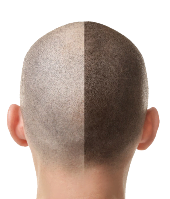 Follicular Unit Transplantation (FUT)