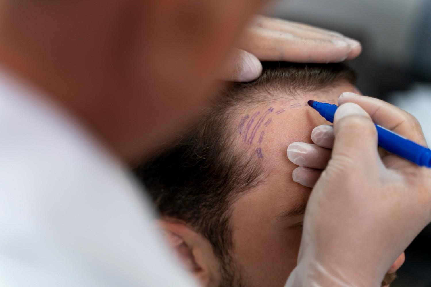 best surgeon for male baldness