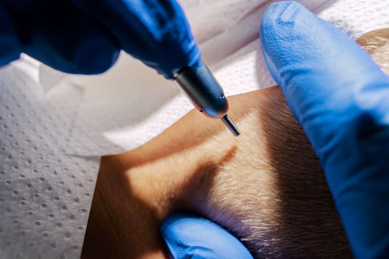 Fort Worth FUE Hair Transplant With Minimal Downtime