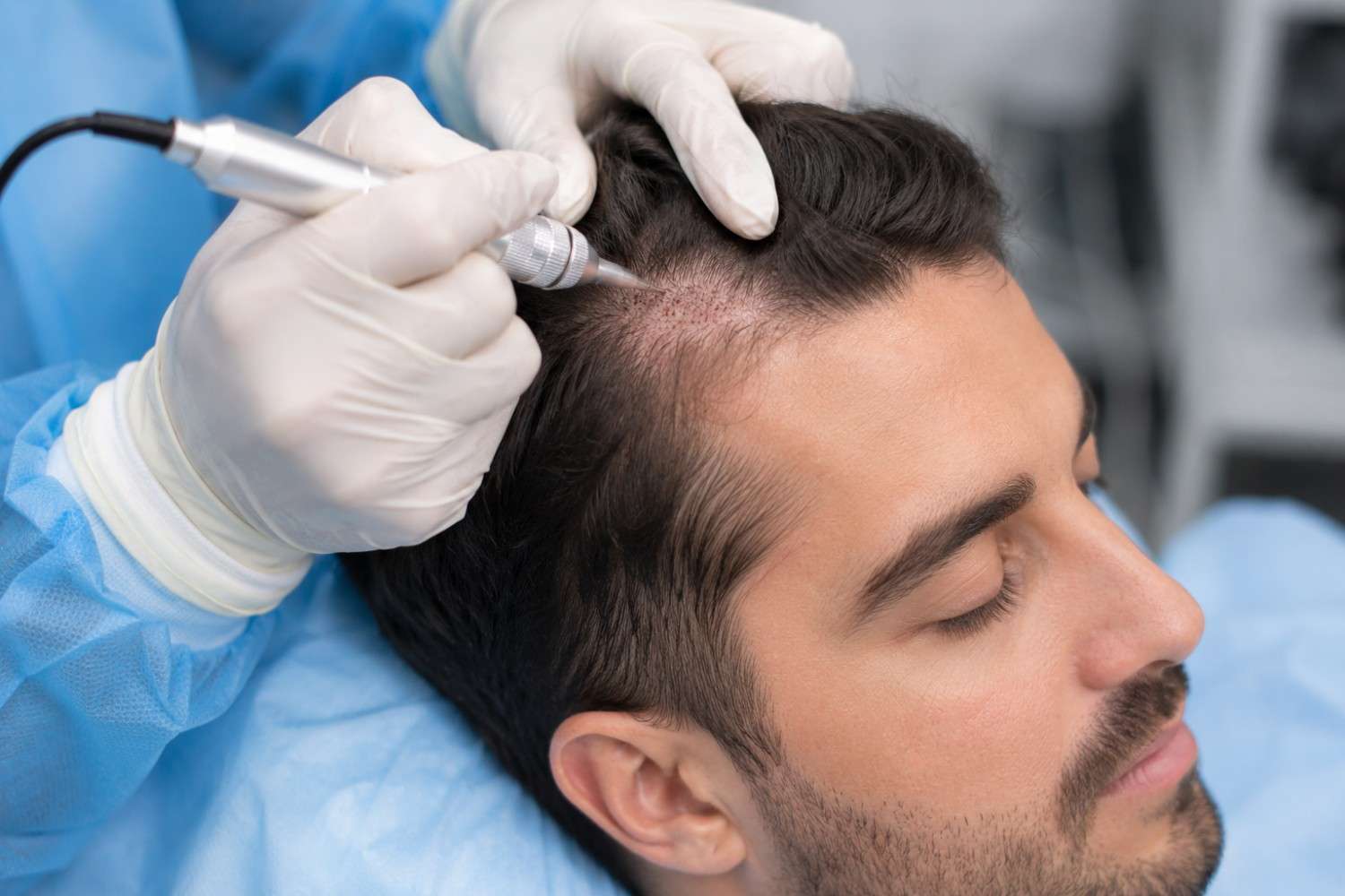 Do Fort Worth Clinics Offer No Shave FUE Hair Transplant?